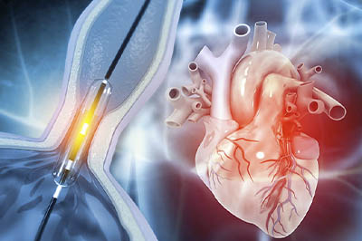 Heart Angioplasty