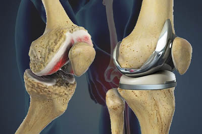 Joint Replacement